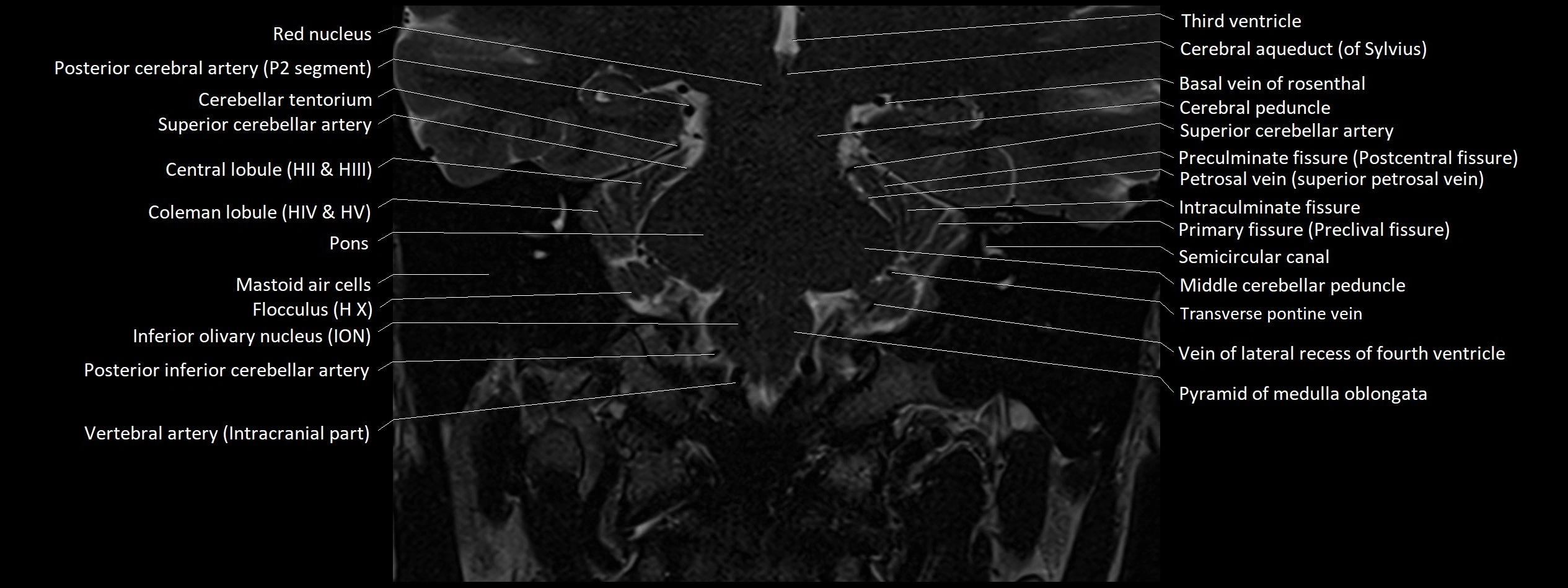 Anatomy of cerebellum coronal cross sectional 3T image 3.webp